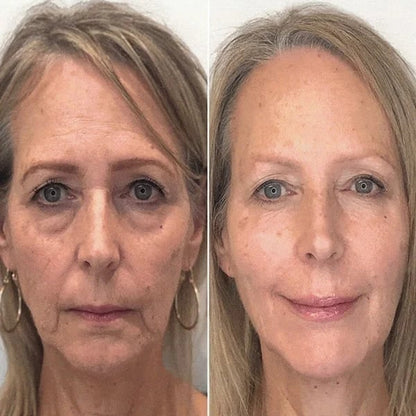 Last Day Promotion 49% OFF - 🔥Botox Face Serum