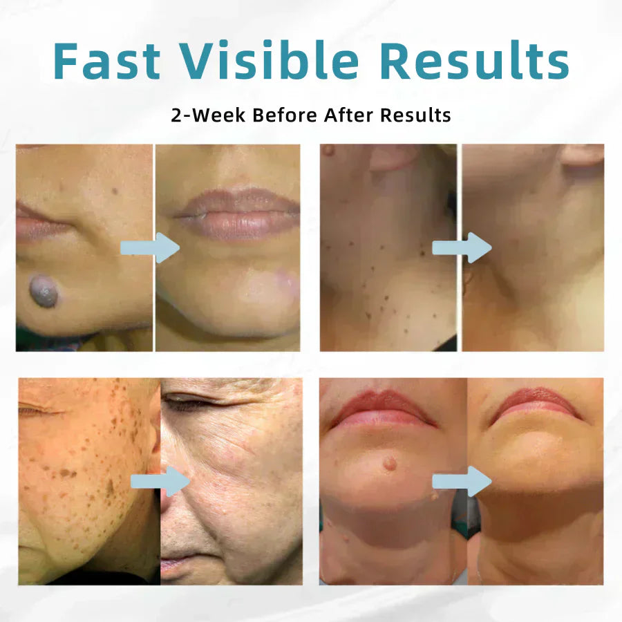 ✨EETTSY™ All-in-One CO₂ Laser Eraser Pen | Removes Moles, Warts, Skin Flaws & Pigmentation