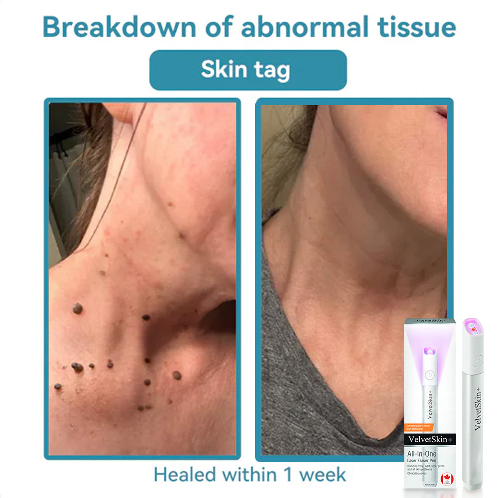 ✨EETTSY™ All-in-One CO₂ Laser Eraser Pen | Removes Moles, Warts, Skin Flaws & Pigmentation